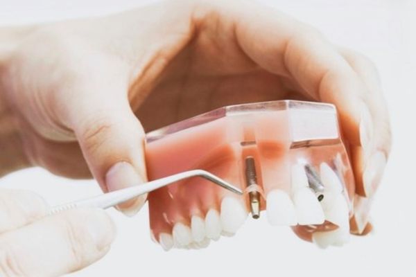 Restorative Dentistry in Thornhill and Richmond Hill - Dental Crowns, Bridges, and Fillings